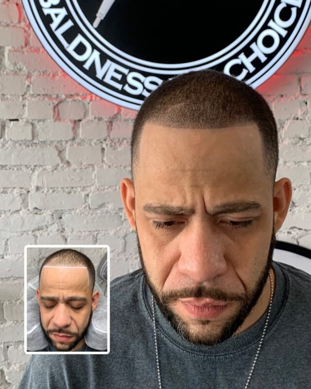 scalp micropigmentation before and after