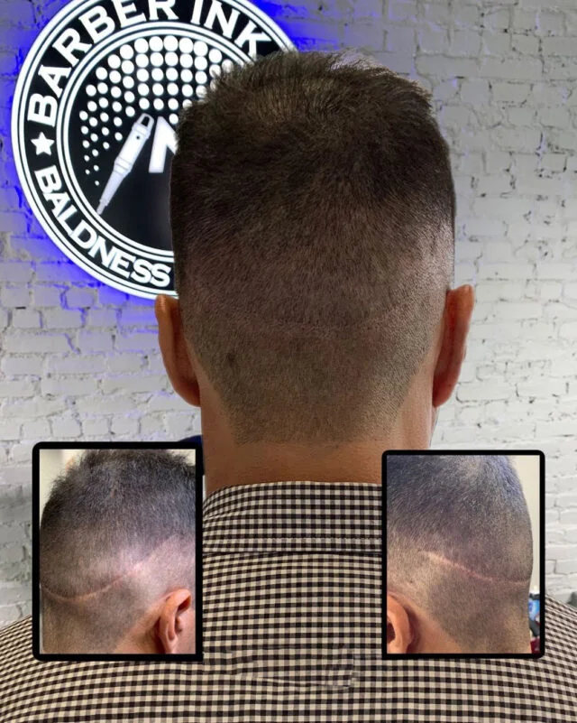 before and after of scar camouflage with scalp micropigmentation